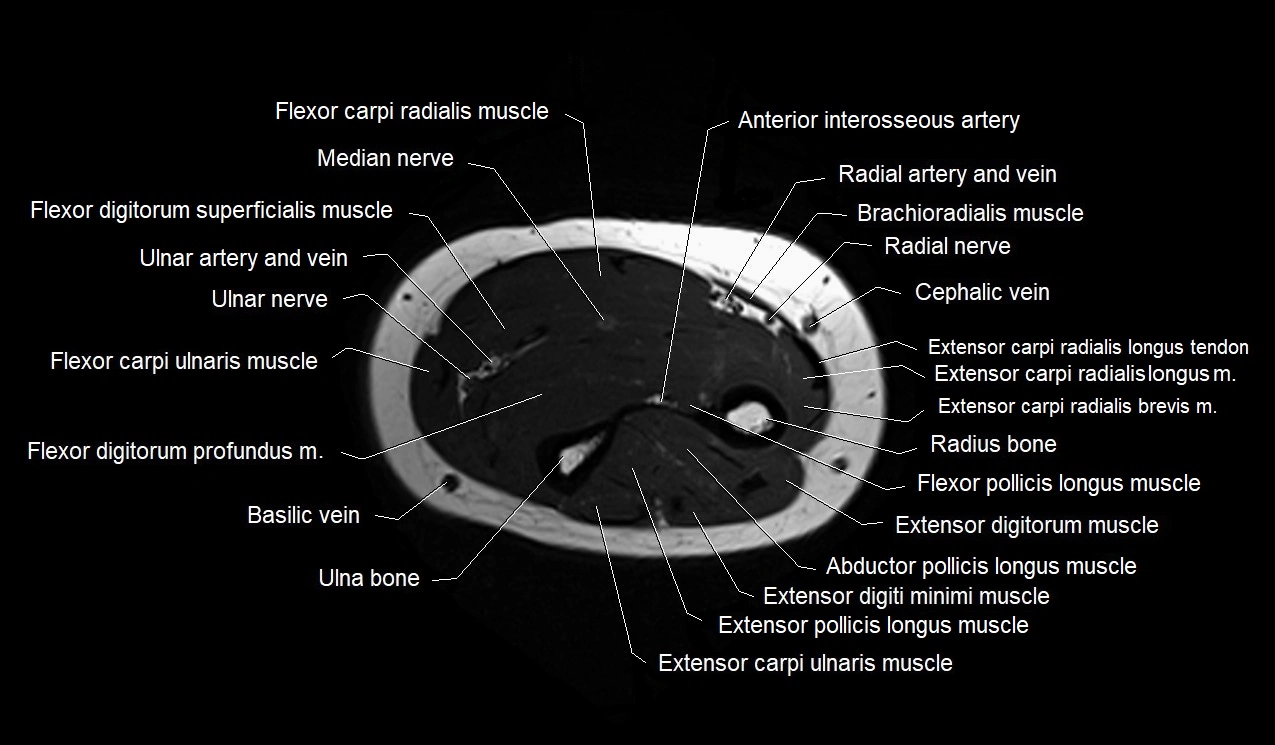 MRI 3T forearm axial cross sectional anatomy image 28.webp